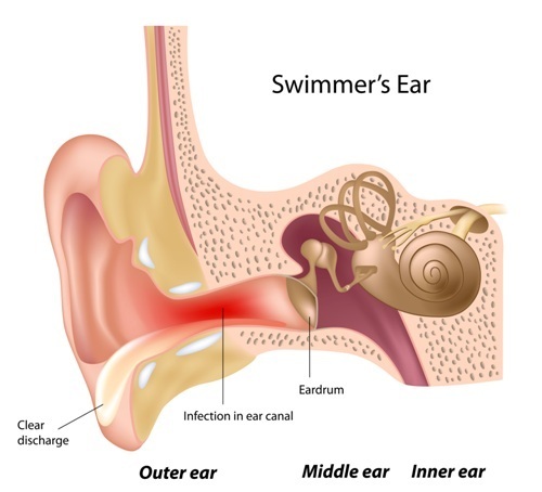 swimmers ear earwax